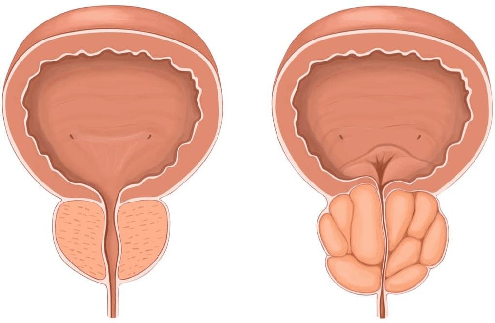 O que acontece com a próstata durante a prostatite